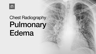 Chest Radiography Pulmonary Edema [upl. by Monte838]