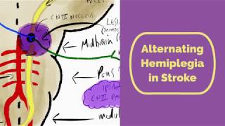 Alternating Hemiplegia in Stroke [upl. by Kiki]