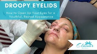 Droopy Eyelids  Treated with CO2 Laser [upl. by Arabelle]