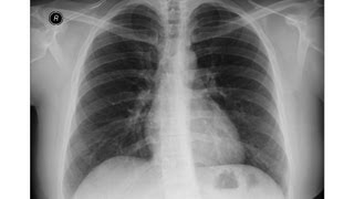 chest xray  Idiopathic Pulmonary Fibrosis [upl. by Eachelle]