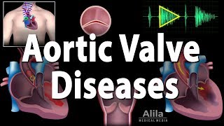 Aortic Valve Disease Animation [upl. by Erised]