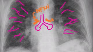 CXR Pneumonias [upl. by Grantham480]