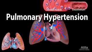 Pulmonary Hypertension Animation [upl. by Akinorev817]