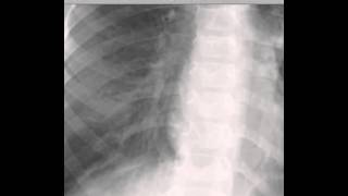 Pediatric Chest Xray Pneumonia DISCUSSION by Radiologist [upl. by Effy]