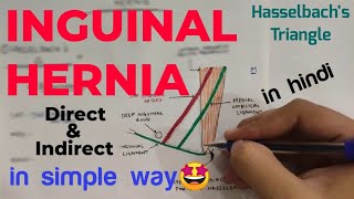 Inguinal Hernia Anatomy 12  Direct and Indirect Inguinal Hernia  Abdomen  Anatomy [upl. by Ahsihat]