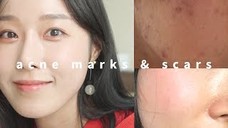 ENG 여드름 자국 흉터 없애는 방법🌙 색소침착 완벽 스킨케어 루틴 ❇︎HOW TO GET RID OF ACNE SCARS amp MARKS 루시파크 LUCY PARK [upl. by Winthorpe]