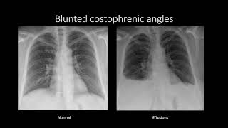 Pleural Effusions [upl. by Meridith]