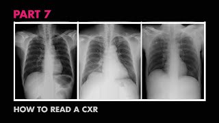 How to Interpret a Chest XRay Lesson 10  Self Assessment Part 2 [upl. by Aissyla]