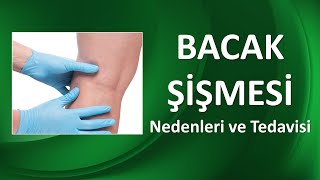 BACAK ŞİŞMESİ NEDENLERİ VE TEDAVİSİ [upl. by Eirolam953]