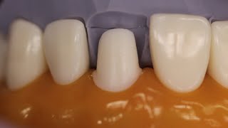 PFM Anterior Tooth Preparation [upl. by Oiramd]