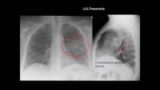 Chest Xray Cases 1 [upl. by Croner]