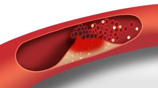 Cholesterol animation  Heart disease risk factors [upl. by Suruat]