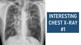 Interesting Chest Xray 1  Cystic Fibrosis [upl. by Aicenav]