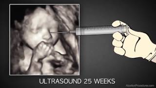 3rd Trimester Abortion [upl. by Lacy]