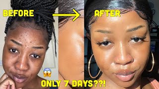 HOW I CLEARED MY SKIN in 1 WEEK and LIGHTENED my dark under eye circles [upl. by Landsman]