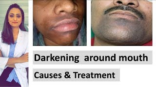 Darkening around mouth  causes  treatment  Dermatologist  Dr Aanchal Panth [upl. by Huberto547]